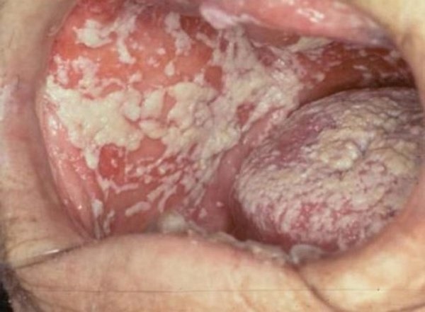 Bác sĩ hãi hùng khi thấy miệng bệnh nhân mốc trắng từng mảng, biết lý do còn choáng hơn-3