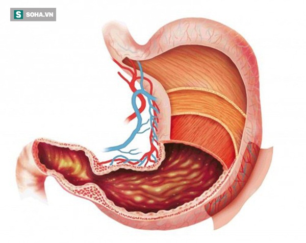 Những nhóm người dễ bị ung thư dạ dày: 3 việc cần làm ngay để ngăn ngừa mắc bệnh-2