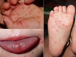 Tiếp nhận nhiều trẻ mắc bệnh tay chân miệng, phụ huynh cần cảnh giác 3 dấu hiệu sớm cảnh báo bệnh của con diễn biến nặng-2
