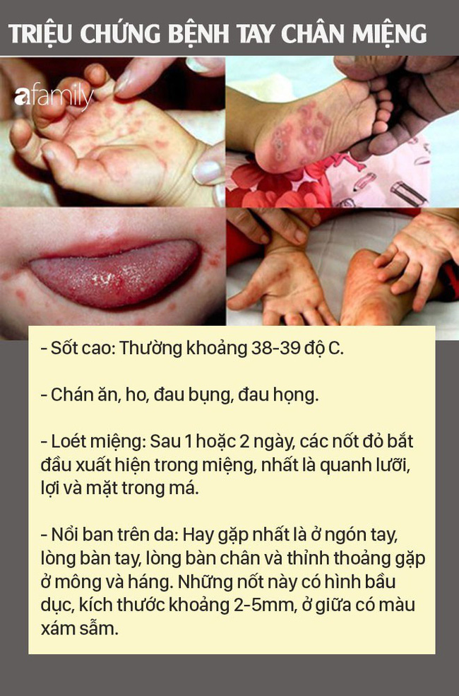 Những việc cha mẹ nào cũng nên làm để phòng bệnh tay chân miệng cho con-1
