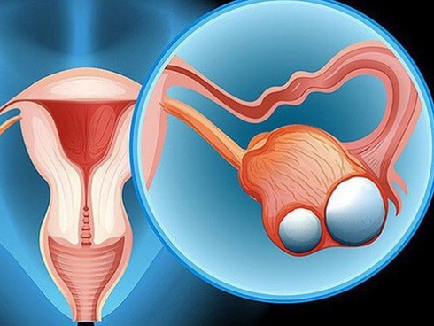 Những nhóm người dễ bị ung thư dạ dày: 3 việc cần làm ngay để ngăn ngừa mắc bệnh-3