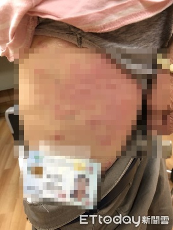 Người phụ nữ mắc bệnh vảy nến nghe lời khuyên tắm tinh dầu dưỡng da, sau 3 tháng hậu quả khôn lường-2