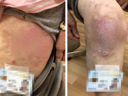 Tắm đủ loại lá, bé trai 2 tuổi bị lở loét toàn thân, vẩy đóng kín đầu-2