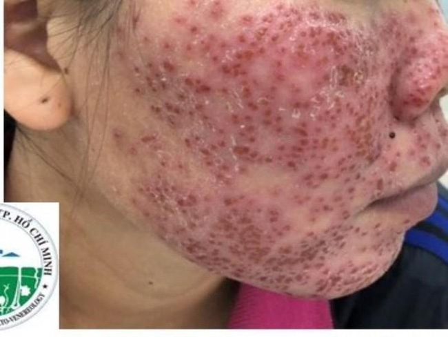 Tự ý lột da mặt để mong sở hữu làn da đẹp bằng những cách được đồn thổi trên MXH, nhiều chị em lĩnh hậu quả cay đắng với gương mặt tan nát”-2