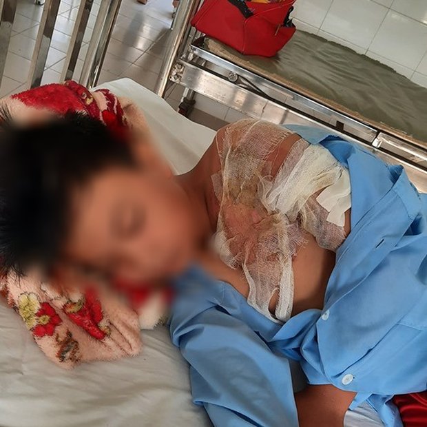 Xác minh thông tin bé trai ở Long An bị cha đẻ bạo hành, đổ nước sôi khiến bỏng nặng phải nhập viện-2