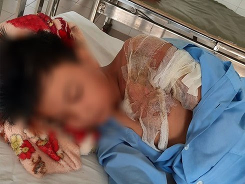 Xác minh thông tin bé trai ở Long An bị cha đẻ bạo hành, đổ nước sôi khiến bỏng nặng phải nhập viện