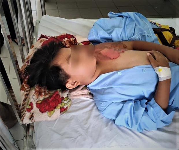 Hoàn cảnh vô cùng bi đát của bé trai nghi bị cha ruột tạt nước sôi gây bỏng nặng-1