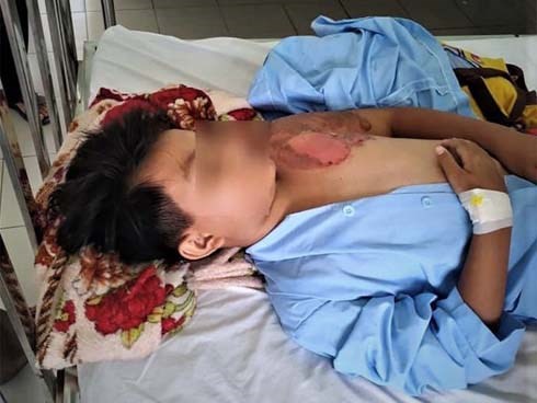 Hoàn cảnh vô cùng bi đát của bé trai nghi bị cha ruột tạt nước sôi gây bỏng nặng