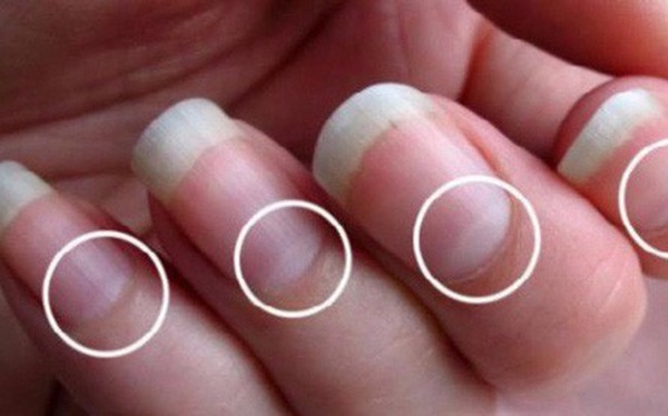 Những dấu hiệu từ móng tay cảnh báo ung thư hoặc gan sắp hỏng-2