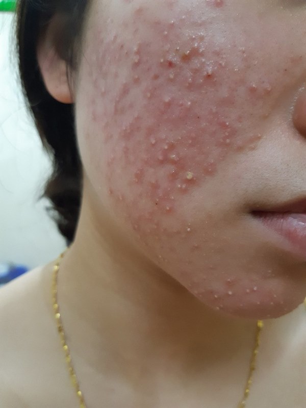 Lăn kim trị mụn: Bác sĩ da liễu khuyến cáo những lưu ý quan trọng không thể bỏ qua trước khi làm-1