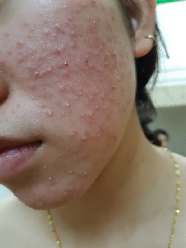 Lăn kim trị mụn: Bác sĩ da liễu khuyến cáo những lưu ý quan trọng không thể bỏ qua trước khi làm-2