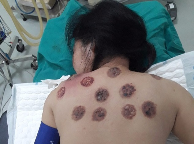 Lưng nhiễm trùng, chảy máu lẫn mủ vì đi giác hơ-1