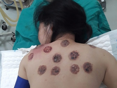 Lưng nhiễm trùng, chảy máu lẫn mủ vì đi giác hơ