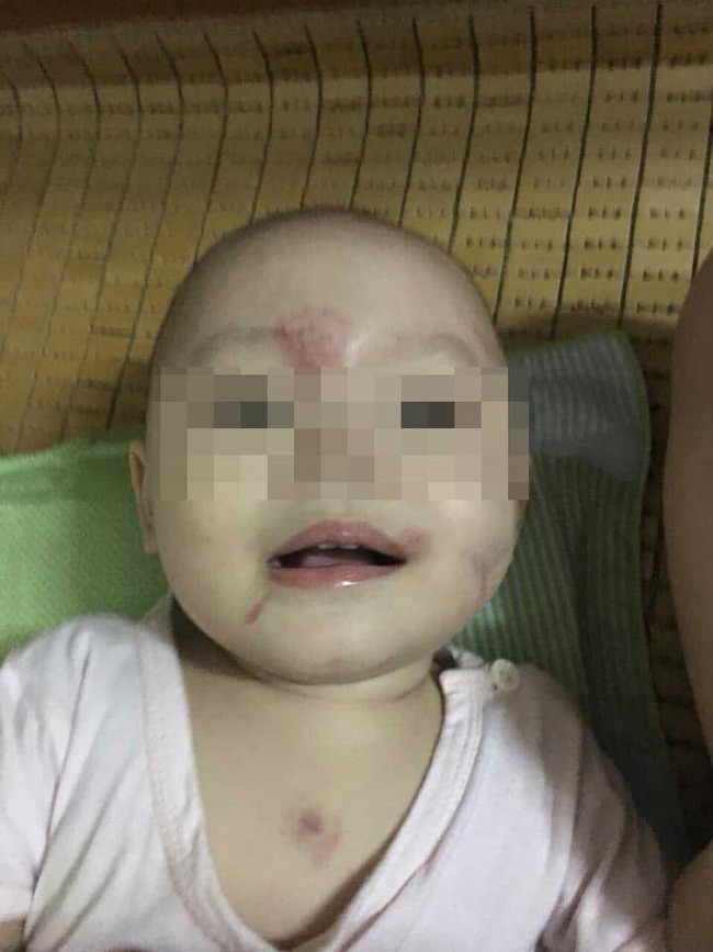 Vụ bé 14 tháng đi học buổi đầu tiên bị bầm tím mặt: Đã xác định nguyên nhân và làm rõ trách nhiệm với 2 giáo viên-1
