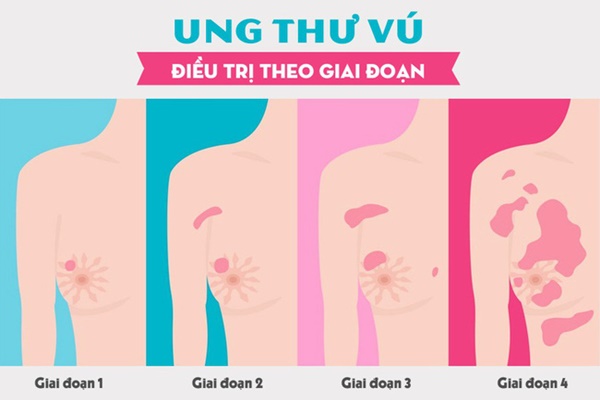 Mang bầu 5 tháng thì phát hiện bị ung thư vú giai đoạn 3, người mẹ chấp nhận mổ và hóa trị ngay trong thai kì để cứu 2 mẹ con-4