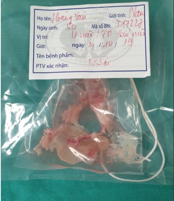 Ổ sán khổng lồ trong não khiến người đàn ông suy giảm trí nhớ nhanh đến kì lạ, tứ chi giảm vận động-2