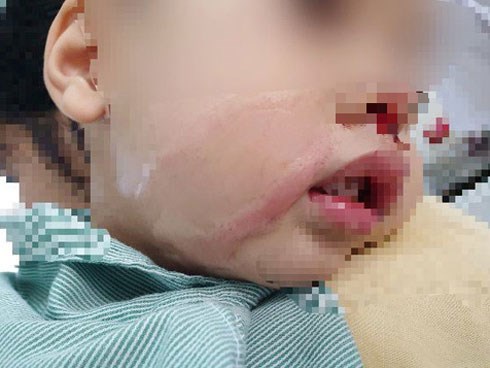 Nhỏ nhầm axit để rửa mũi khiến bé trai bị bỏng nặng