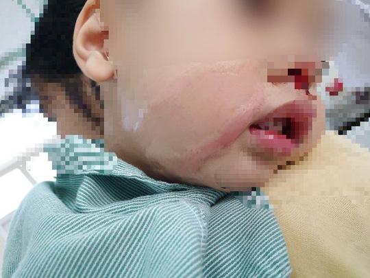 Nhỏ nhầm axit để rửa mũi khiến bé trai bị bỏng nặng-1
