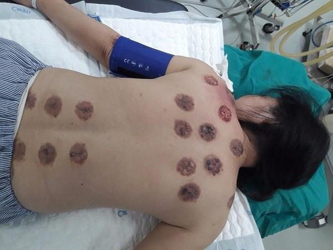 Hoại tử da nặng nề vì đi giác hơi chữa đau mỏi vai gáy: Chuyên gia lưu ý trước khi làm cần nhớ điều này-1