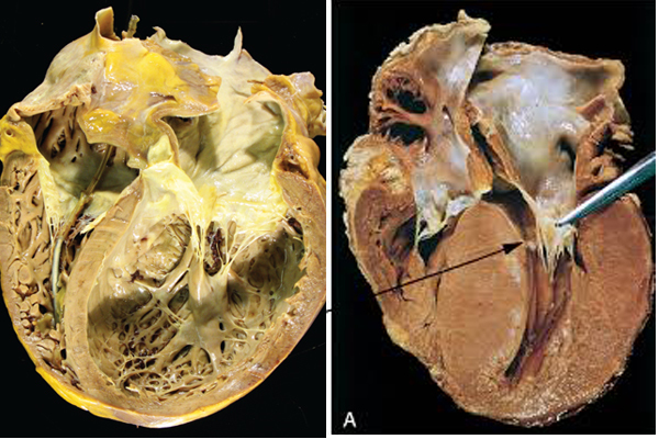 Hà Nội thông báo kết quả điều tra dịch tễ 2 ca tử vong do viêm cơ tim-1
