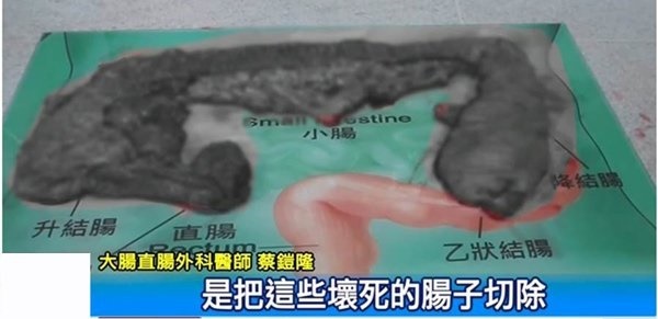 Không rửa tay sau khi sờ vào trứng, người phụ nữ bị hoại tử 90% ruột-2