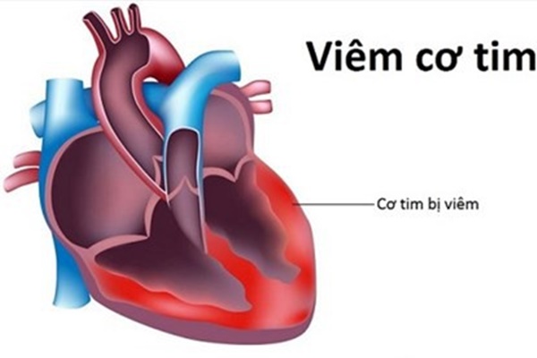 Viêm cơ tim - Một số điều bệnh nhân cần biết: Khi nào thì cần đi khám và những xét nghiệm cần thực hiện-2