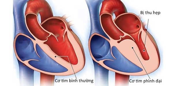 Viêm cơ tim - Một số điều bệnh nhân cần biết: Khi nào thì cần đi khám và những xét nghiệm cần thực hiện-3
