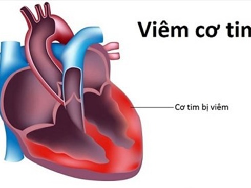 Kết quả điều tra chính thức tin đồn virus lạ khiến 2 phụ nữ tử vong vì viêm cơ tim-3