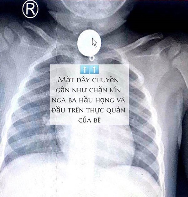 Bé trai 2 tuổi suýt chết vì thói quen đeo dây chuyền cho con mà nhiều gia đình vẫn làm-1