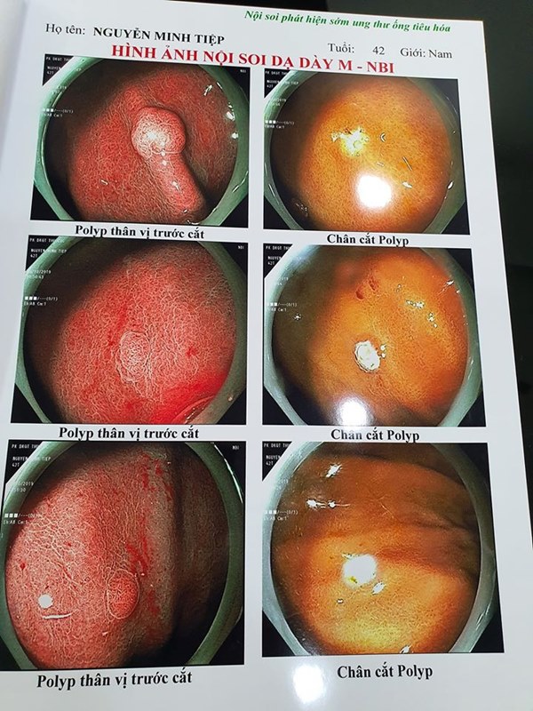 Bệnh polyp đại tràng và polyp dạ dày mà diễn viên Minh Tiệp vừa phát hiện có thể tiến triển thành ung thư không?-2