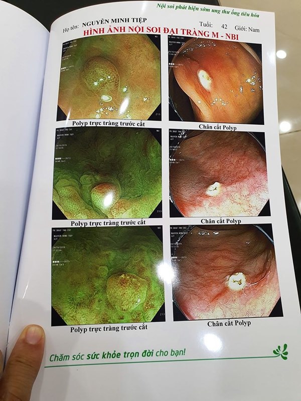 Bệnh polyp đại tràng và polyp dạ dày mà diễn viên Minh Tiệp vừa phát hiện có thể tiến triển thành ung thư không?-3
