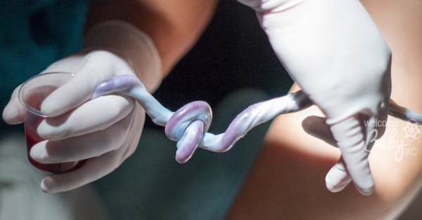 Cứu sống thai nhi có dây rốn thắt nút hiếm gây gặp cản trở tuần hoàn-2