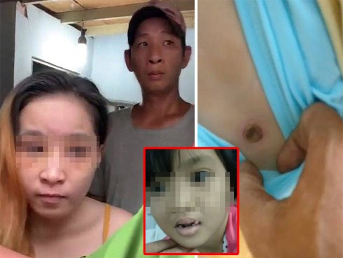 Phẫn nộ khi nghe về quá trình cha dượng châm tàn thuốc, bạo hành cơ thể qua lời bé gái