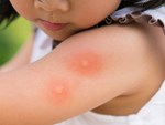 Cảnh báo sốt xuất huyết gây nguy hiểm ở trẻ nhỏ đặc biệt ở những trẻ nhũ nhi-2
