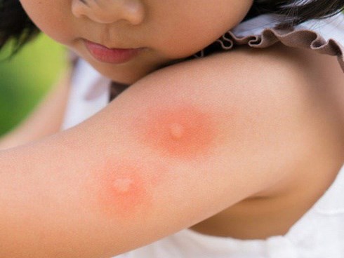 Chỉ cần 1 người trong nhà bị sốt xuất huyết, thực hiện ngay 4 biện pháp sau để không ai bị lây bệnh