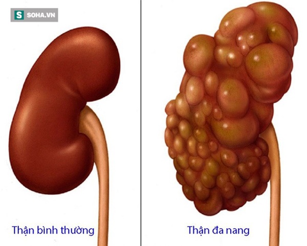 Thận là nhà máy lọc nước của cơ thể: Ai muốn giữ thận khỏe mạnh nên làm 5 việc-1
