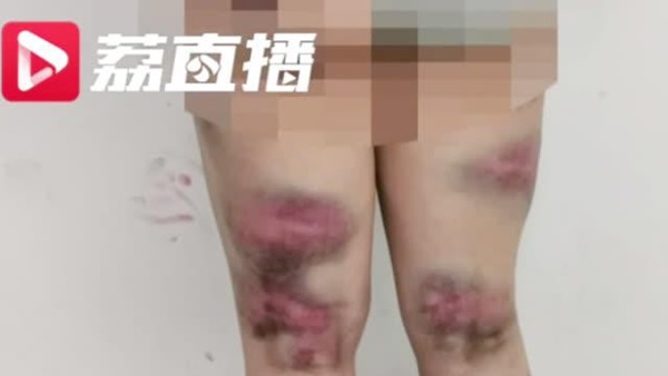 Con gái ế 30 tuổi bị mẹ đánh đến trọng thương, nguyên nhân đằng sau khiến người ta vừa thương, vừa giận nạn nhân-3