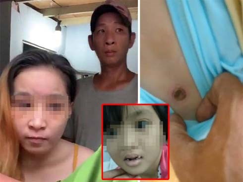 'Châm thuốc lá vào bé gái 6 tuổi, sao cha dượng tàn nhẫn thế?'