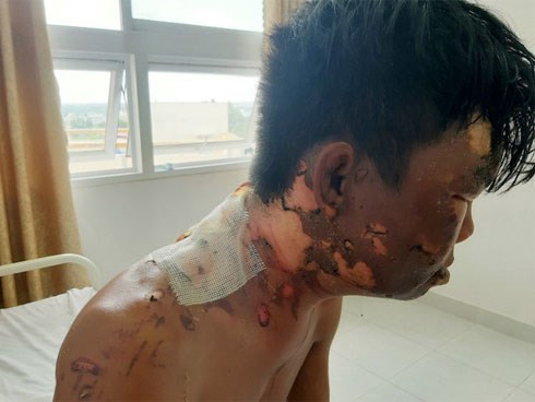 Thanh niên bị chị ruột đổ nước sôi vào đầu