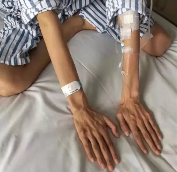 Hội chứng lạ khiến người phụ nữ có chân tay gầy, dài bất thường-1