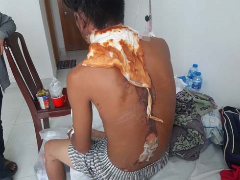 Công an vào cuộc xác minh clip nam thanh niên nghi bị người thân đổ nước sôi lên người gây bỏng nặng