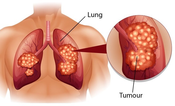 Dấu hiệu điển hình của bệnh ung thư phổi-1
