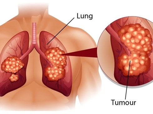 Dấu hiệu điển hình của bệnh ung thư phổi