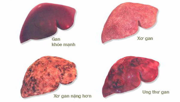 Giám đốc BV K hướng dẫn cách phòng bệnh ung thư có tỷ lệ mắc mới nhiều nhất tại Việt Nam-1