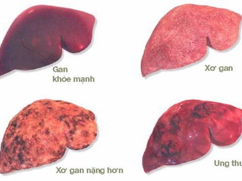 Giám đốc BV K hướng dẫn cách phòng bệnh ung thư có tỷ lệ mắc mới nhiều nhất tại Việt Nam