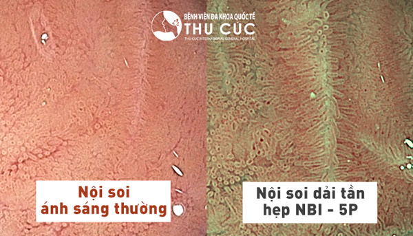 Nội soi tiêu hóa tại Thu Cúc, nhận gói khám sức khỏe miễn phí-1