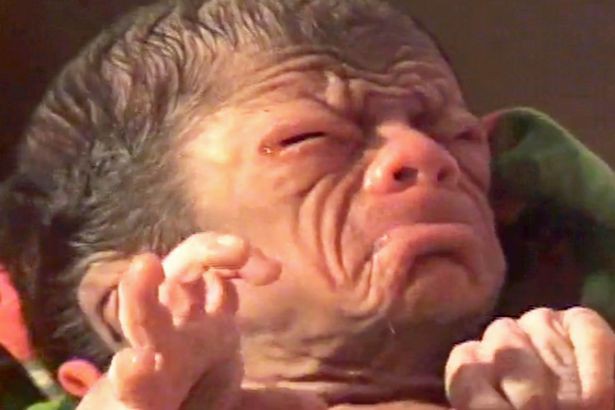 Cả ê-kíp bác sĩ đỡ đẻ choáng váng khi em bé chào đời trong hình hài của một ông lão 80 tuổi-1