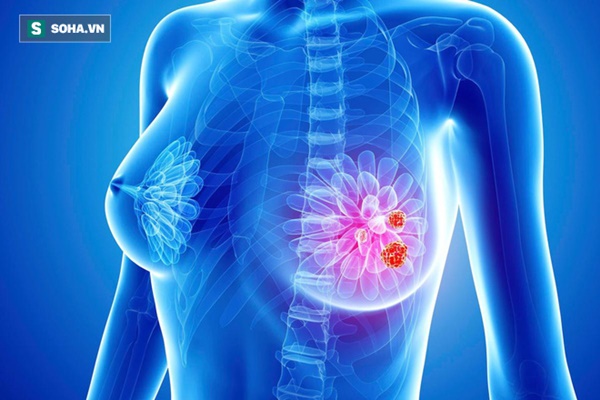 3 kiểu ung thư khiến người bệnh không tin vào nguyên nhân: BS chỉ ra sát thủ giấu mặt-2