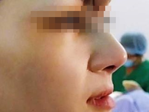 Nữ nhân viên ngân hàng 27 tuổi suýt mù vì tiêm filler nâng mũi ở spa tư nhân-2