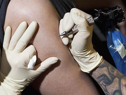 Nhập viện sau 4 ngày xóa xăm-2